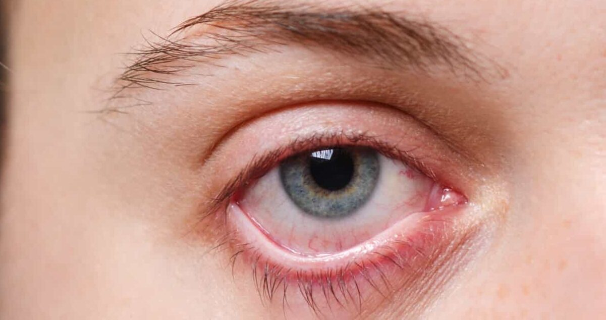 Vaak last van droge ogen?